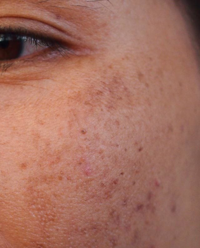 Melasma / Cholasma / Pigmentation