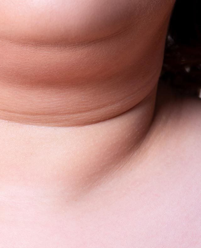 Neck Fat