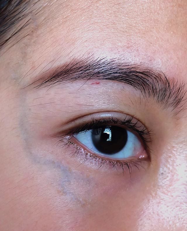 Veins Under Eyes: Causes & Treatment Options