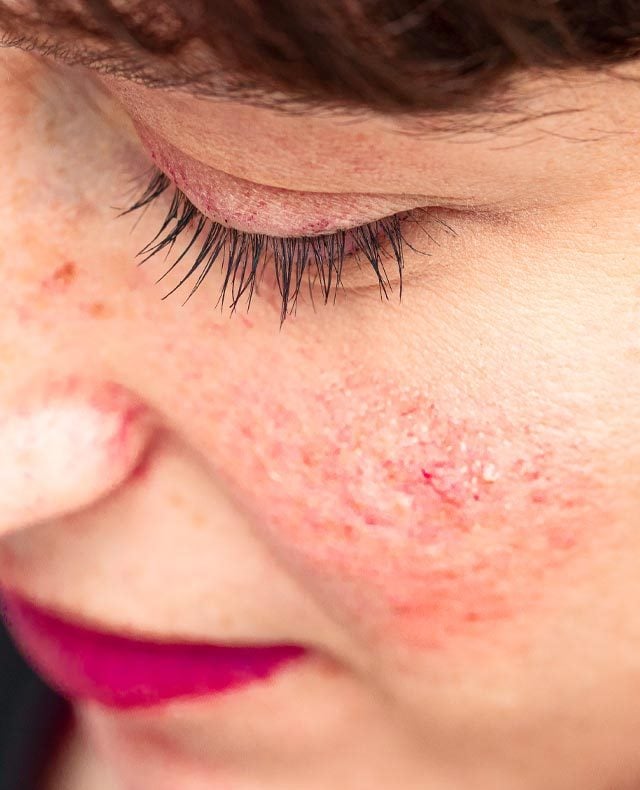 Rosacea