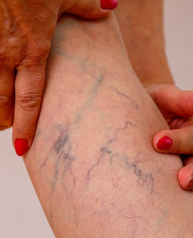 Varicose Veins