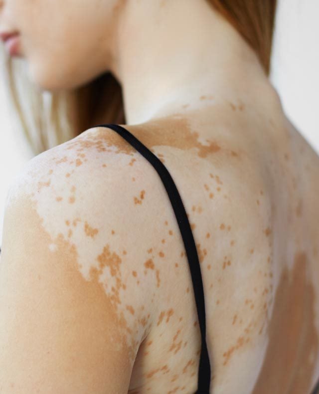 Top more than 143 vitiligo tattoo best