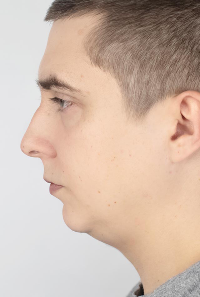 Weak Jaw Zenith Cosmetic Clinics
