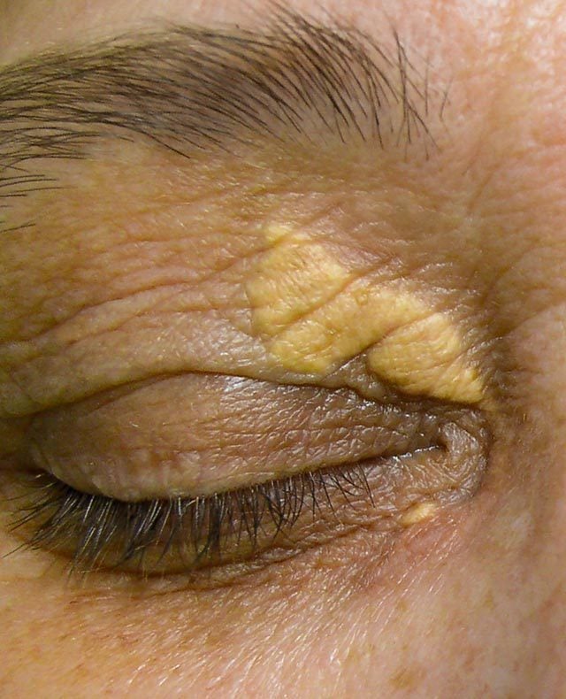 how do i remove cholesterol deposits under eyes