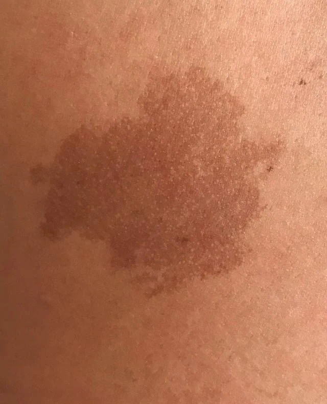 brown birthmarks