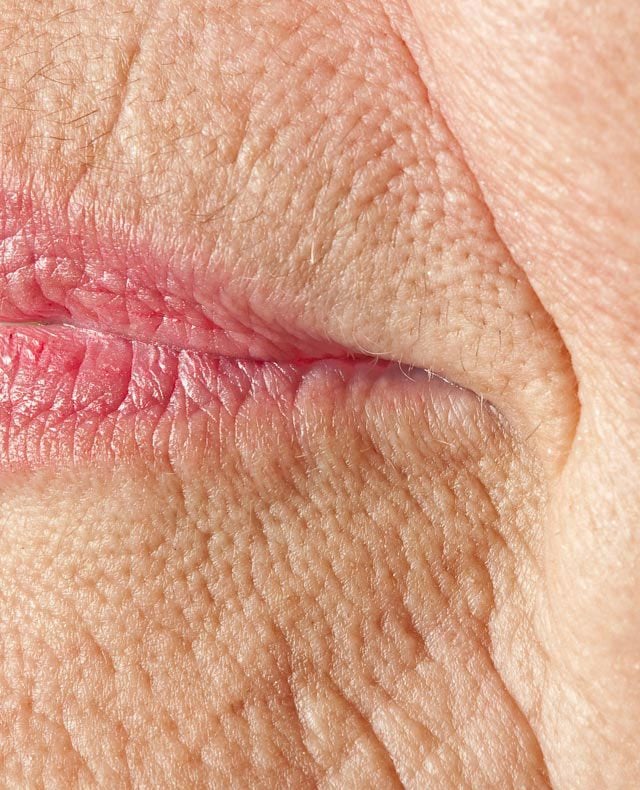 VERTICAL LIP LINES