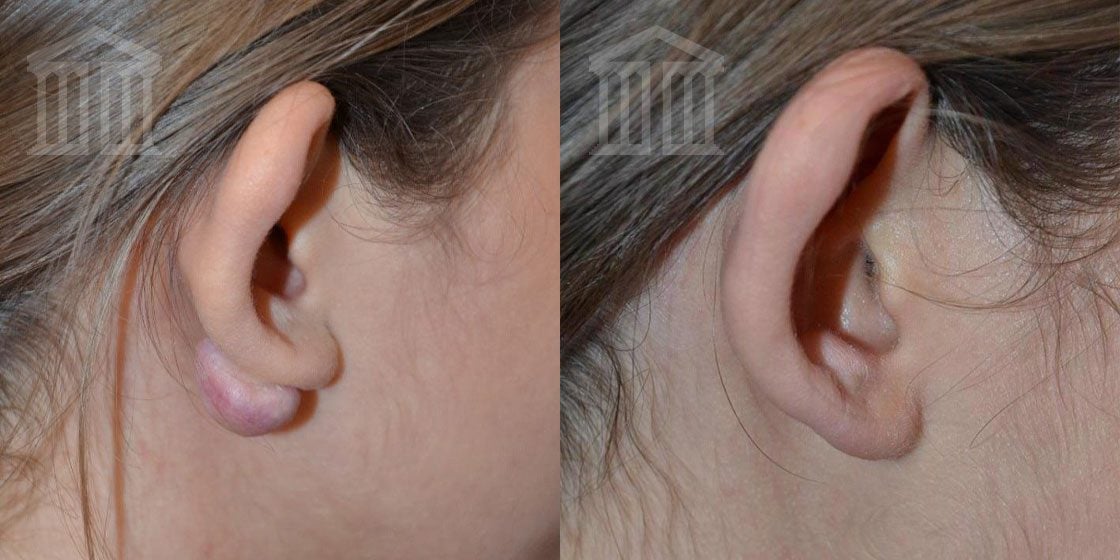 Before & After: Mole Lasering & Scar Removal