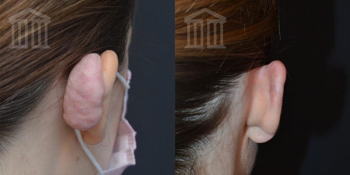 Ear Keloid Removal | Zenith Cosmetic Clinics