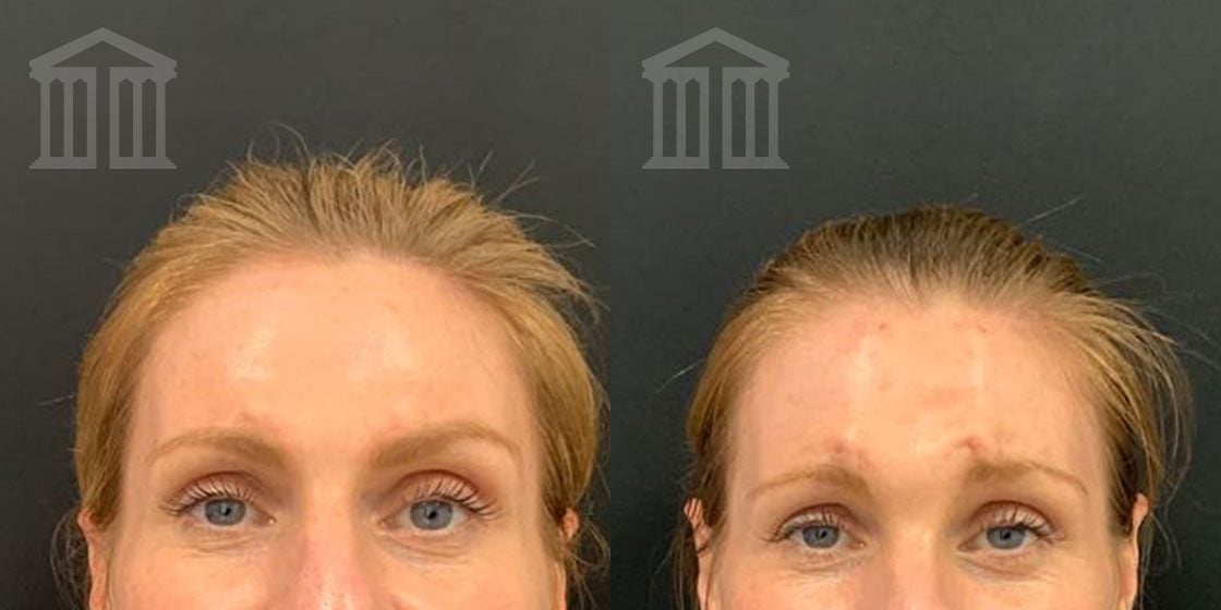 Before and After: Brow Lift