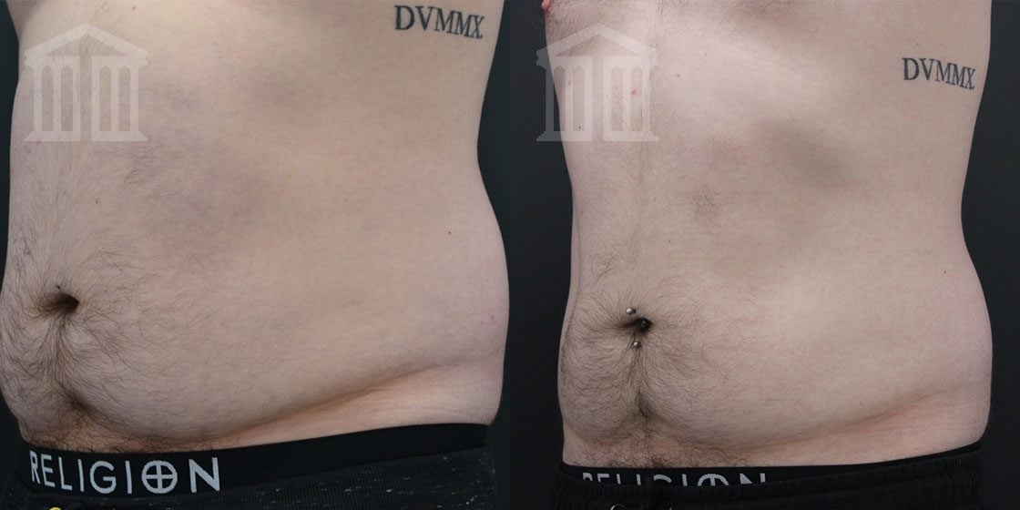 Before and After: Cristal Fat Freezing