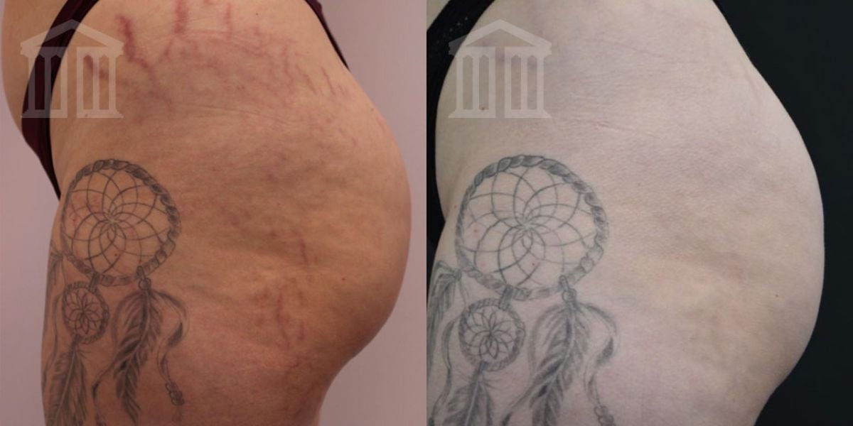 Before & After: Cutera Laser Genesis