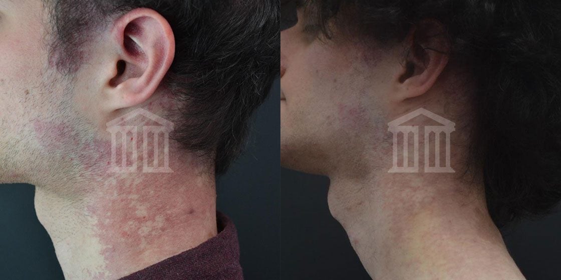 Before & After: Cutera Laser Genesis for Men