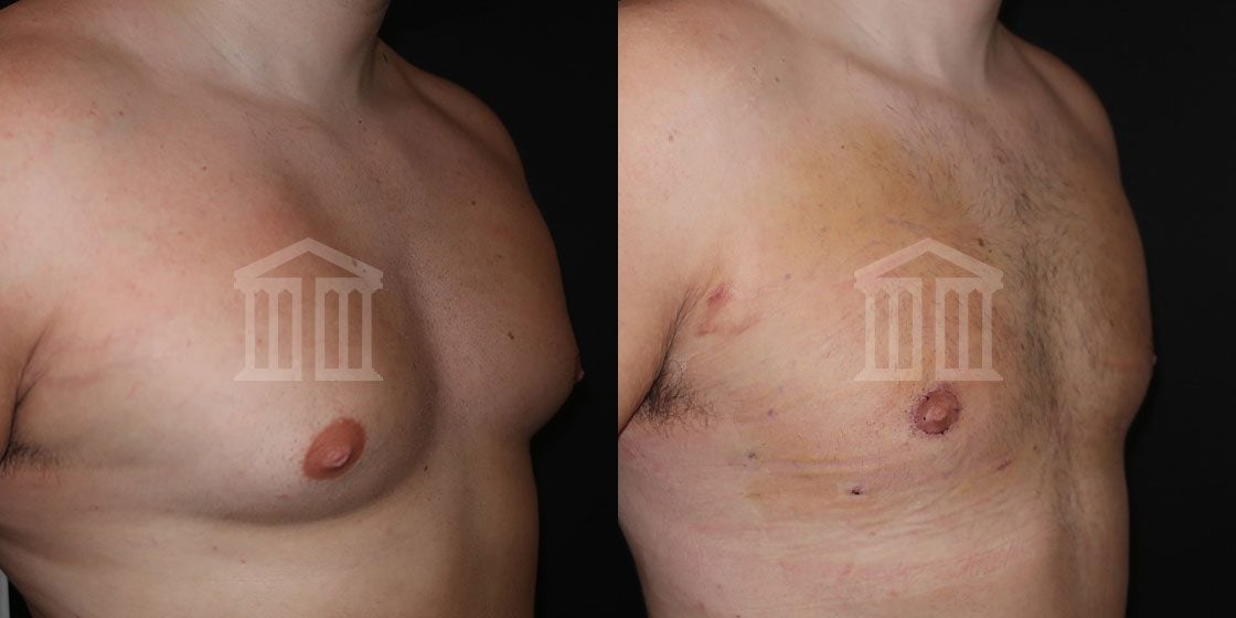 Male Chest Reduction - Gynecomastia Surgery, Men Boobs Lipo London