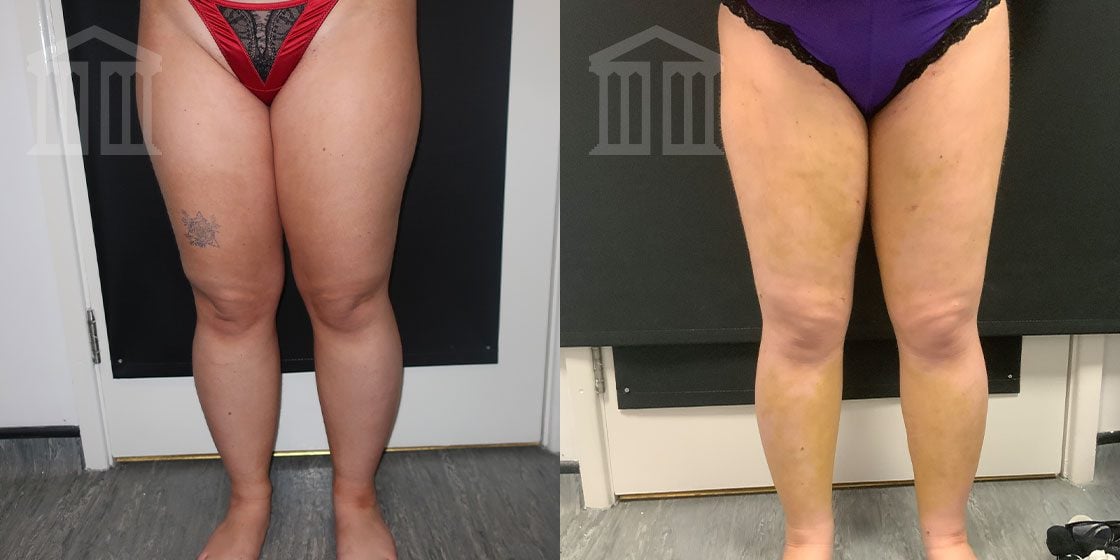 Before and After: Liposuction