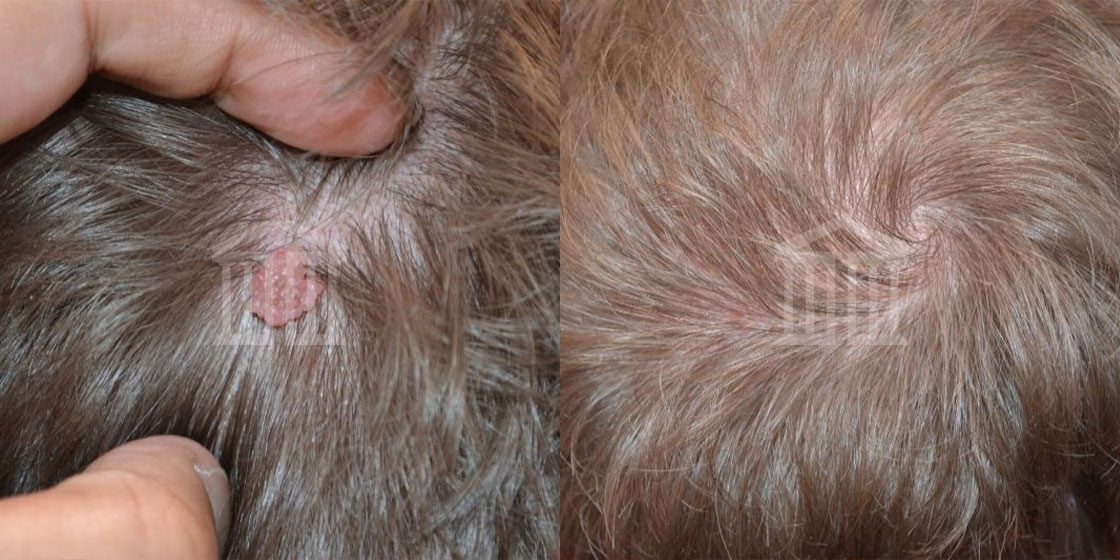 Before & After: Male Laser Mole & Scar Removal