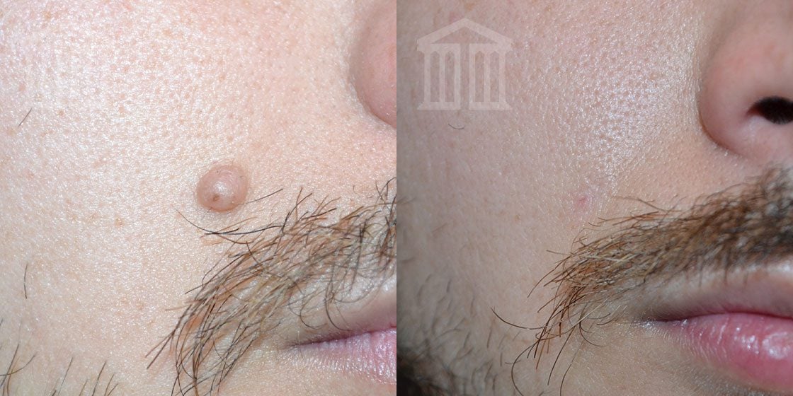 Safe and Painless Mole Removal