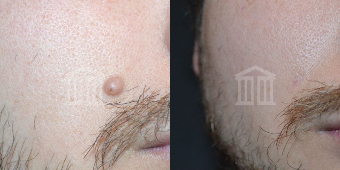 Before & After: Male Mole Removal