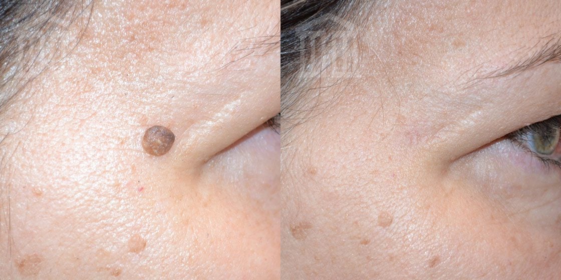 Effective Skin Lesion Removal