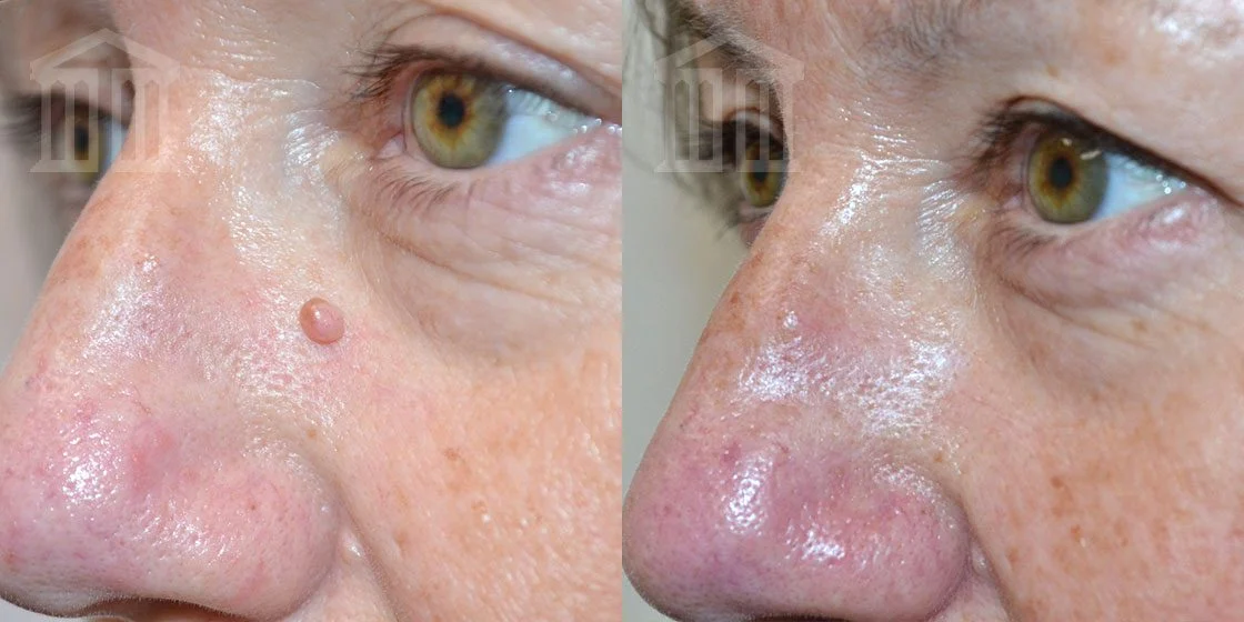 mole removal before and after Nottingham