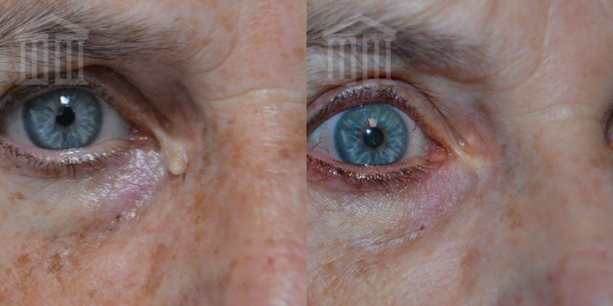 mole-removal-before-and-after-54-nottingham