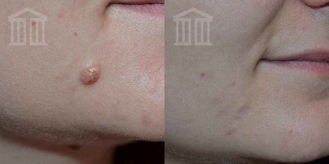 Mole Removal Consultation in Nottingham