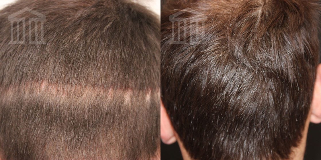 Hair Transplants UK  Hairloss & PRP Clinic Leicester