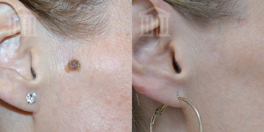 Radiosurgery Mole Removal Zenith Cosmetic Clinics 