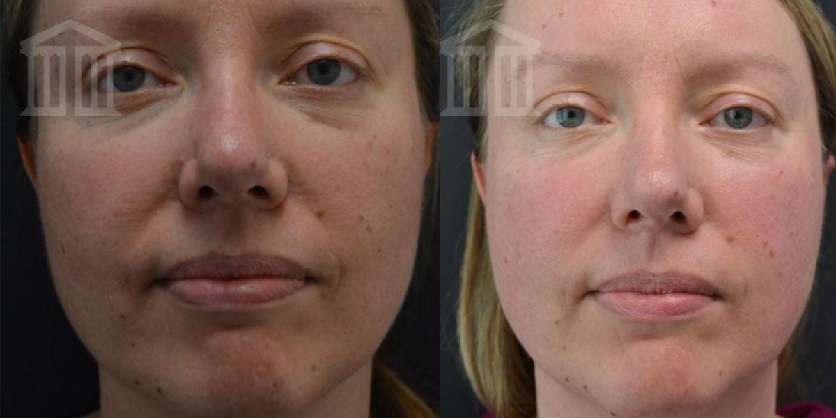 Before & After: Face Fillers