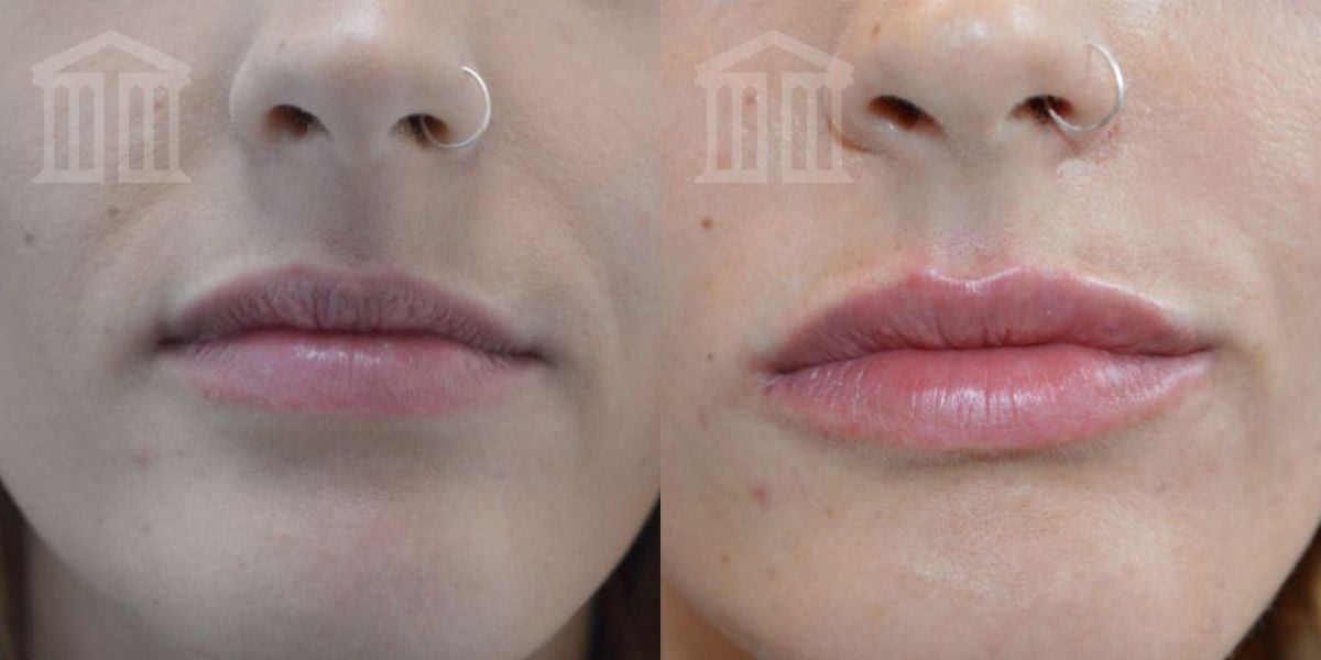 Before & After: Lip Filler