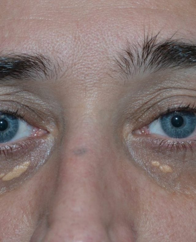 Xanthelasma Removal