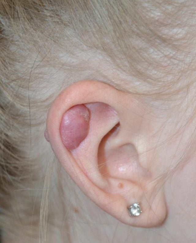 keloids on ears