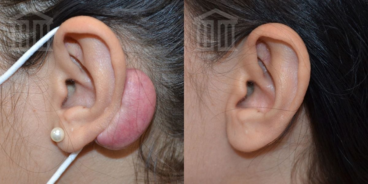 Before & After Ear Keloid Removal