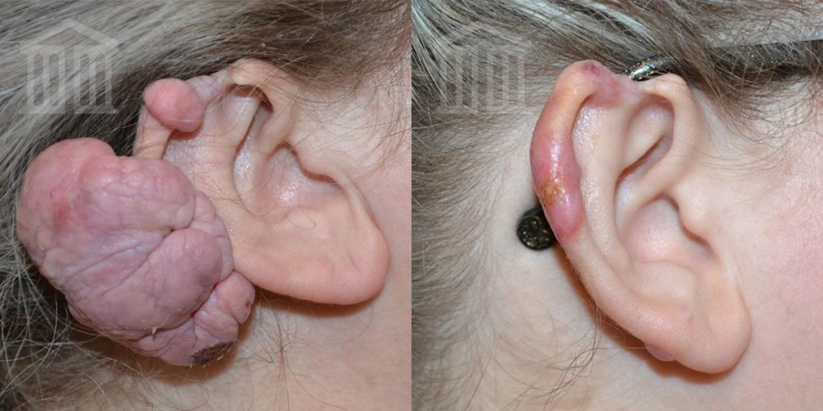 Ear Keloid Removal Zenith Cosmetic Clinics