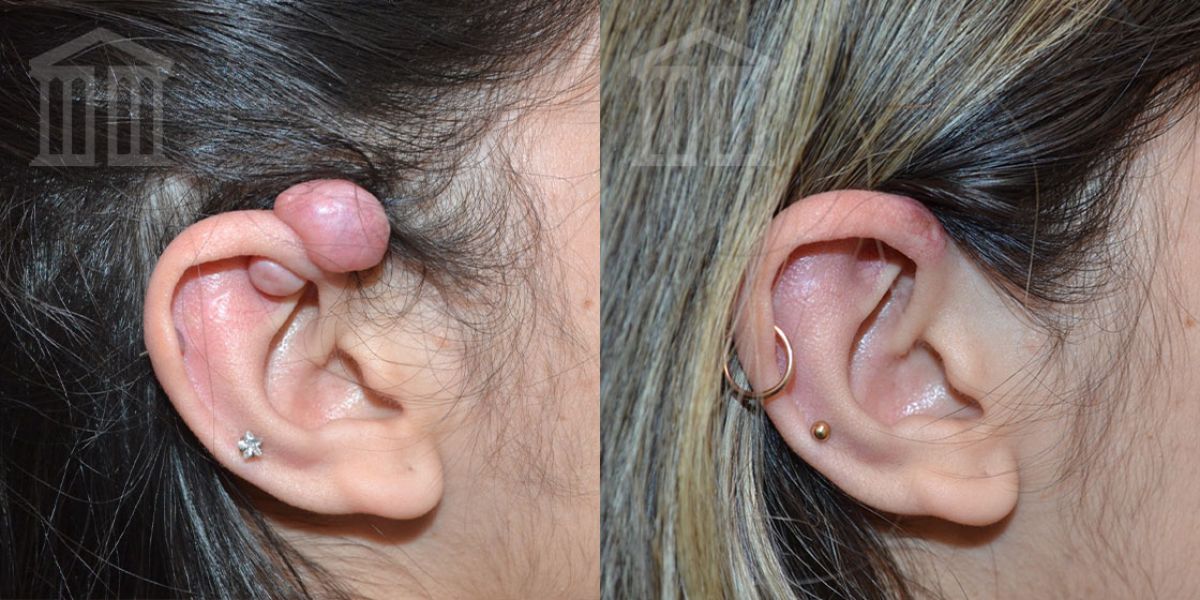 Keloid on Ear: What It Is, Piercing, Removal, Scar, Behind Ear