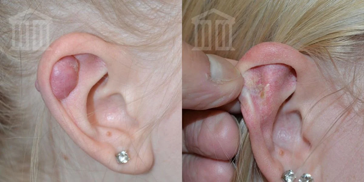 earlobe keloid removal