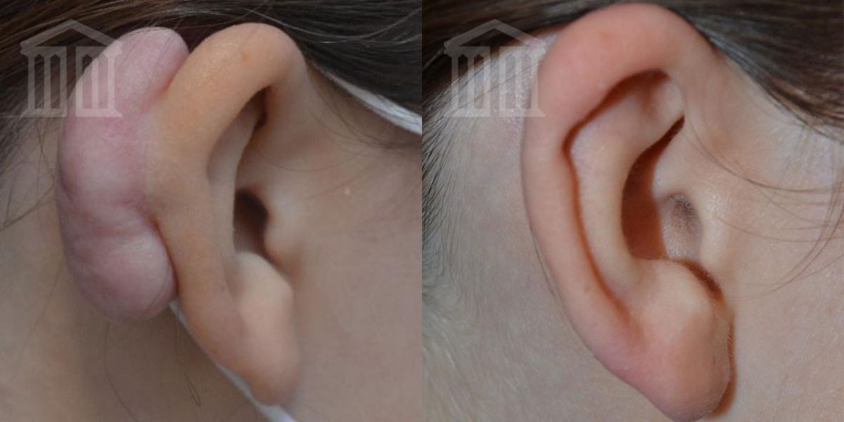 earlobe keloid removal