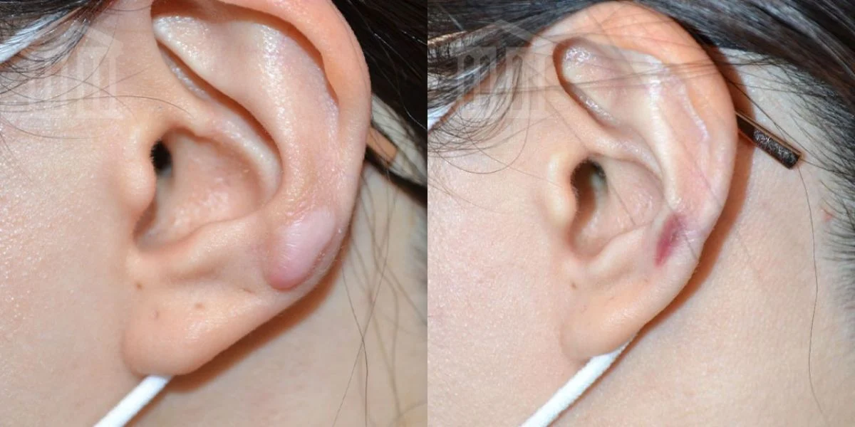 ear-keloid-removal-9-nottingham-before-and-after.