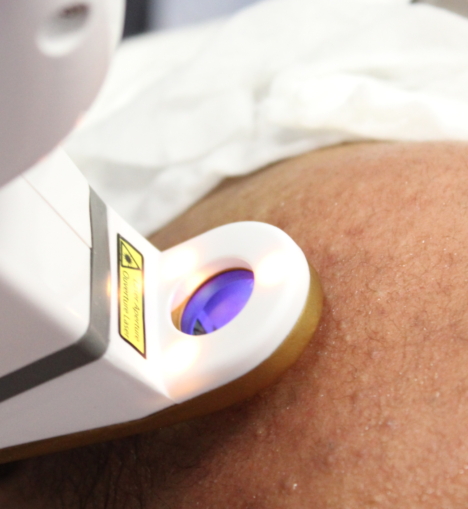 Say Goodbye to Acne: How AviClear Revolutionises Skin Treatment