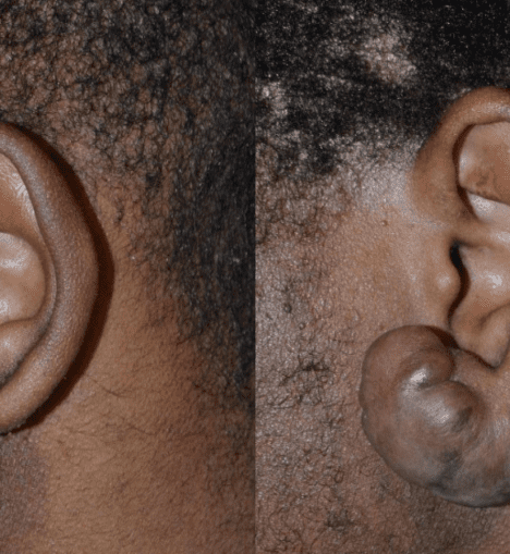 Understanding Keloid Scars: Causes, Symptoms, and Treatment Options 3 Understanding Keloid Scars: Causes, Symptoms, and Treatment Options