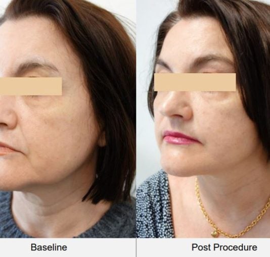 How HiFu Lifts the SMAS Layer Without Surgery: The Science Behind the Magic 1 How HiFu Lifts the SMAS Layer Without Surgery: The Science Behind the Magic