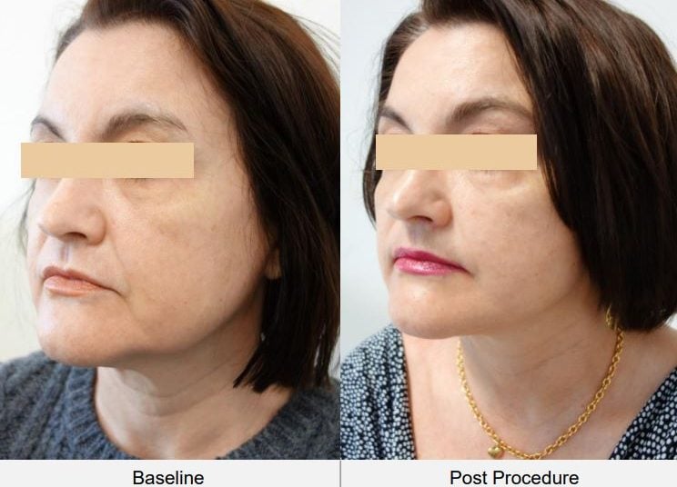 How HiFu Lifts the SMAS Layer Without Surgery: The Science Behind the Magic 2 How HiFu Lifts the SMAS Layer Without Surgery: The Science Behind the Magic