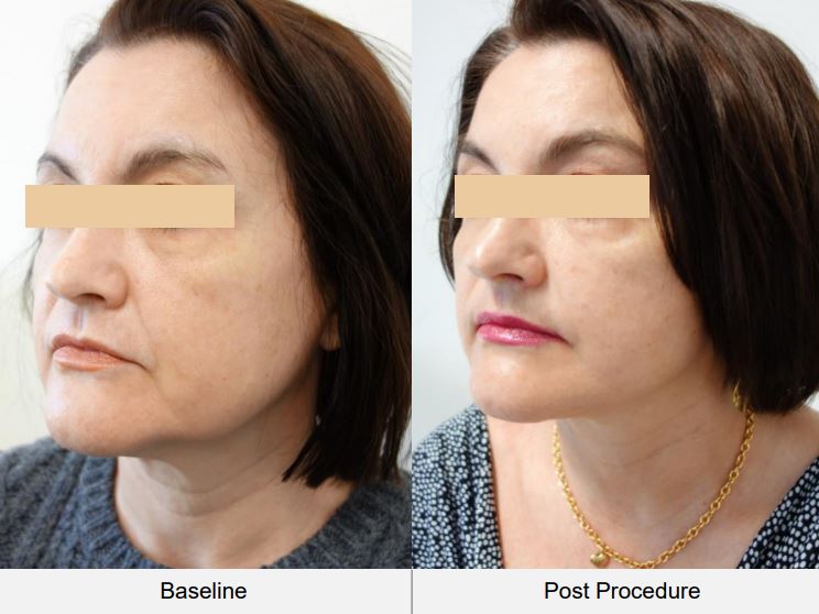 How HiFu Lifts the SMAS Layer Without Surgery: The Science Behind the Magic 1 How HiFu Lifts the SMAS Layer Without Surgery: The Science Behind the Magic